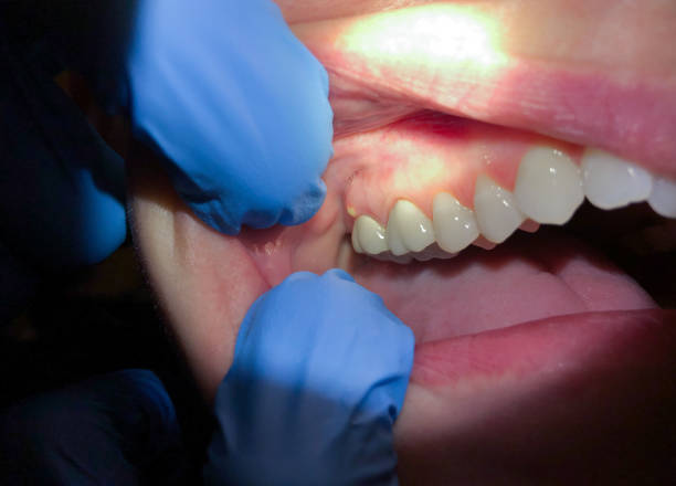 Best Tooth Infection Emergency Dentist  in Westby, WI